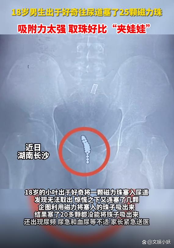18岁男生出于好奇往尿道塞了25颗磁力珠，取珠好比“夹娃娃”