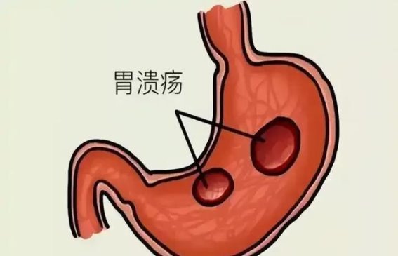 胃部疾病常用的五大治疗药物