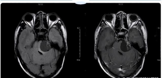 53岁男子耳鸣加重，发现4公分听神经瘤