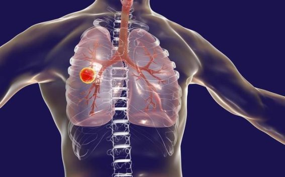 磨玻璃结节需要终身随访