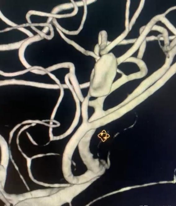 12岁男孩大脑动脉瘤成功治疗，解除生命威胁