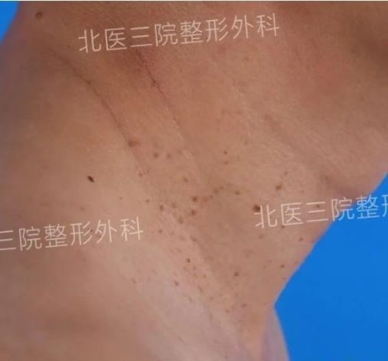 扁平疣治疗：激光去除的方法与注意事项