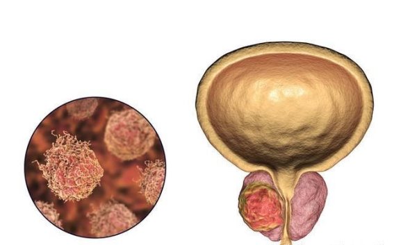 尿路结石和尿路感染同时发生时，身体会发出哪些信号？