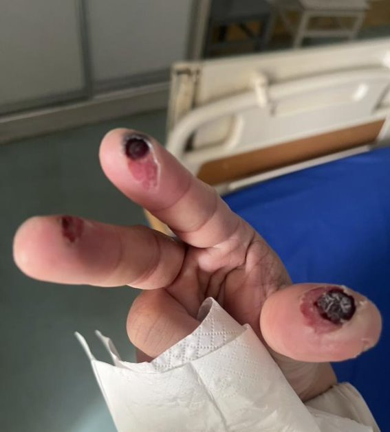 男子因化学清洁剂灼伤三根手指险些失去手指 专家提醒：务必佩戴防护手套