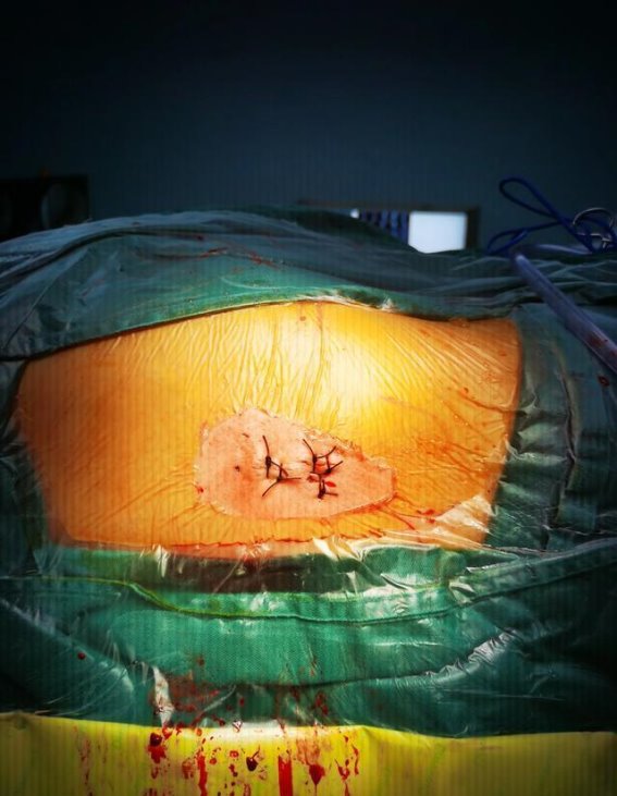 精细手术：股骨头坏死的“停止键”