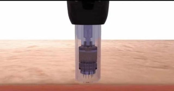 微针技术治脱发，湖口县人民医院提供新希望