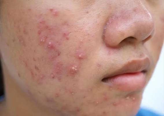 冬天常喝蒲公英茶的人，身体可能出现这四种变化