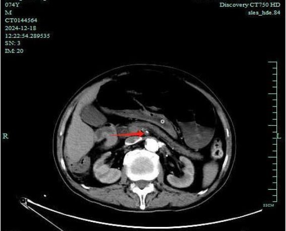 小血栓，生命危机——程爷爷的肠系膜上动脉栓塞