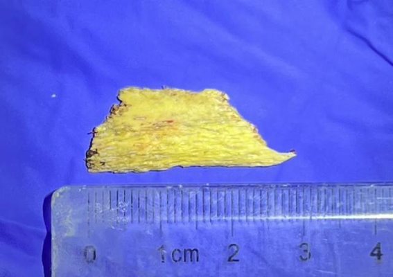 吃猪蹄差点丧命！医生发出重要提醒！