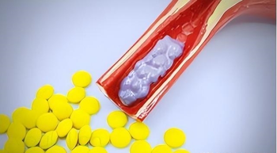 冬季脑梗死亡率增高，5个方法预防不可忽视