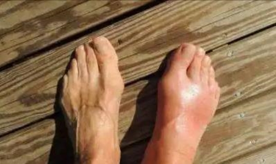 高尿酸的几大坏习惯，别等关节病来才后悔