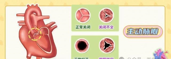 主动脉瓣关闭不全的原因和危害