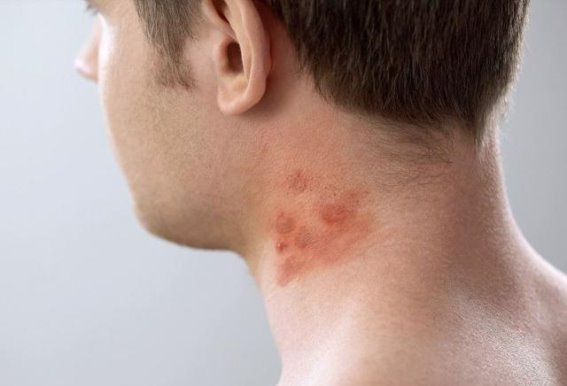 肝癌的早期信号，很多人没注意到的皮肤变化