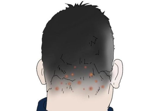 头皮疙瘩和脓包频繁出现，可能是这些疾病在作祟