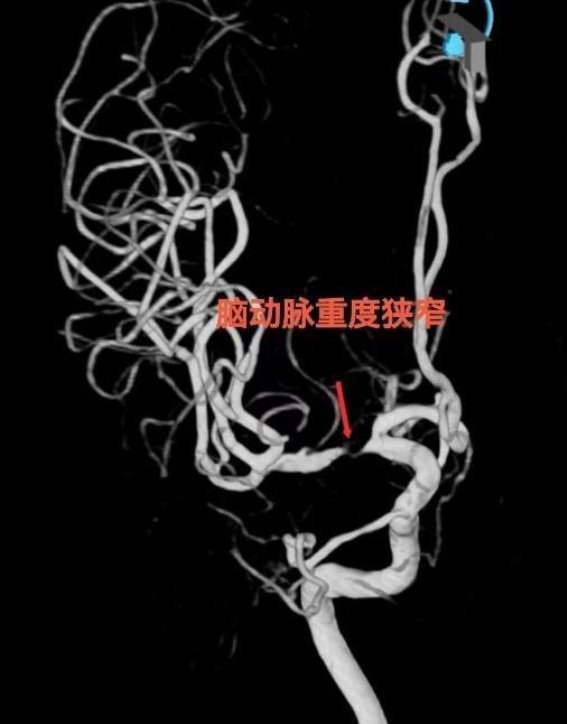 奉贤区中心医院创新治疗方案破解大脑中动脉狭窄难题