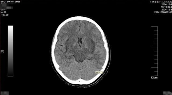 14岁女孩误服“敌草快”农药，生死时速中的抢救奇迹